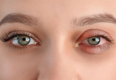 Specialized Care for Allergic Conjunctivitis​