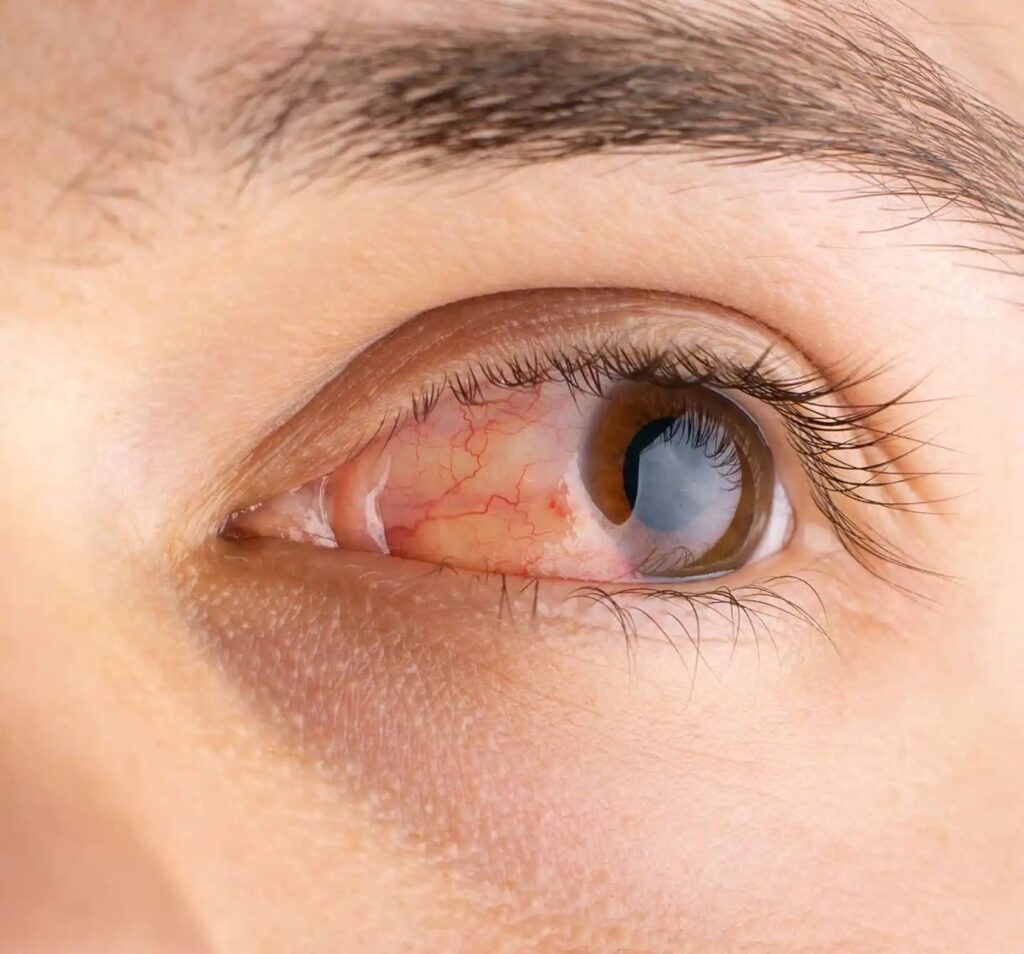 Close-up image of an irritated, red eye showing symptoms of allergic conjunctivitis – ideal for Allergic Conjunctivitis treatment in Indore.