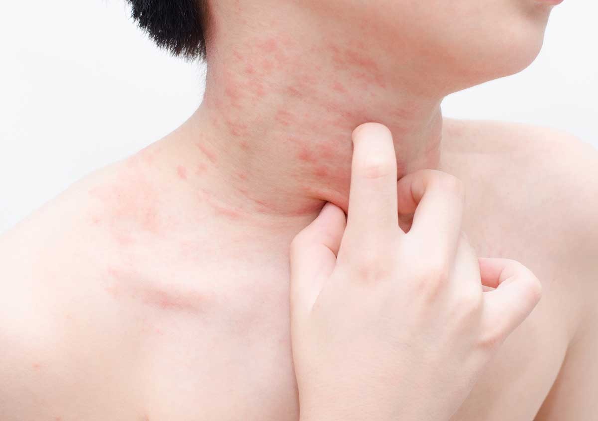 Food allergy symptoms causing red itchy rashes on the neck treated with Food Allergy Treatment in Indore by Dr. S. Z. Jafrey.