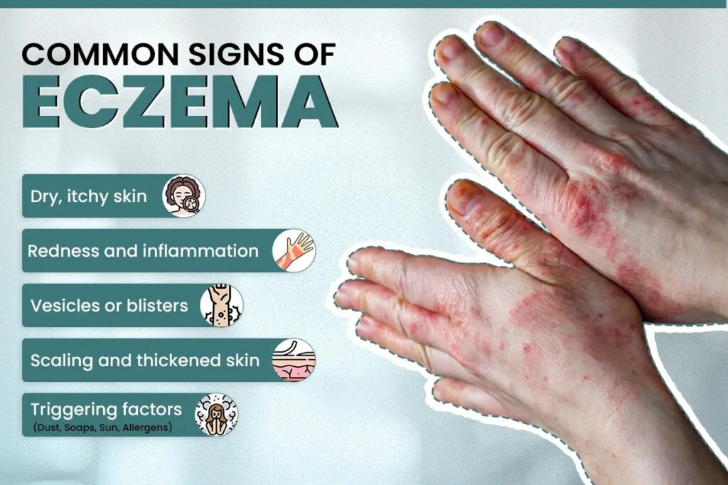 Common signs of eczema shown on hands, including redness, itching, scaling, and blisters, explained by Dr. S.Z. Jafrey, a leading skin allergy specialist in Indore.