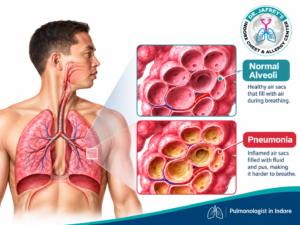 Normal and Pneumonia Alveoli Explained